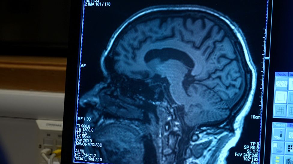 Aldos Gehirn wurde regelmäßig gescannt, um die Auswirkungen von Aducanumab zu erkennen