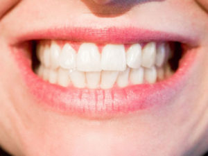 7 natürliche Hausmittel für Zahnkaries