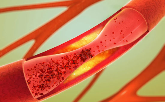 16 natürliche Wege&Tipps zur Senkung des Cholesterinspiegels (zu Hause!)