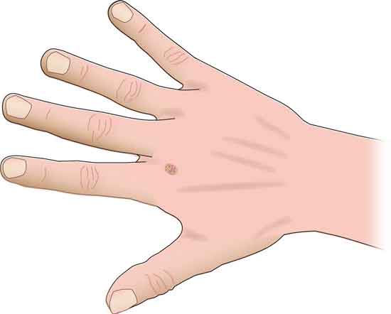 12 Möglichkeiten, Warzen am Finger zu entfernen