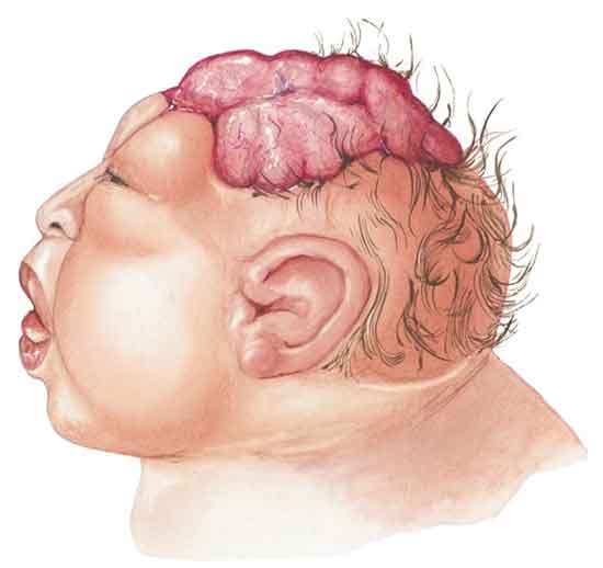 Was ist Anenzephalie Ursachen, Symptome und Behandlung (Vorbeugung)