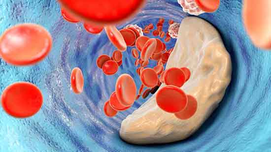 4 Nebenwirkungen von zu hohem Cholesterinspiegel