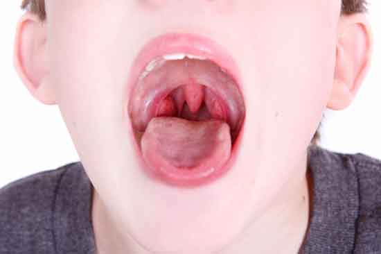 8 Nebenwirkungen der Mandelentfernung (Tonsillektomie)