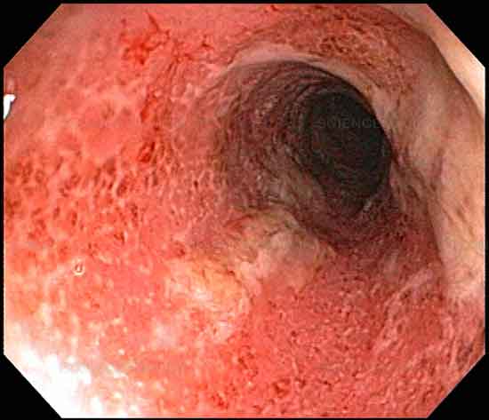 Behandlung von Colitis ulcerosa