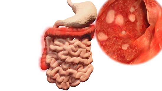 Colitis ulcerosa Komplikationen, Krebsrisiko, Medikamente