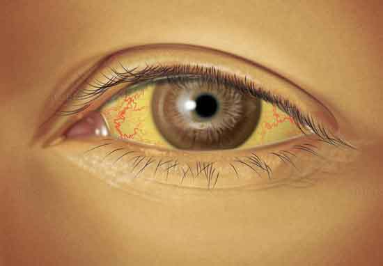 Gelbes Auge (Ikterus) 7 Gründe + Heimbehandlung