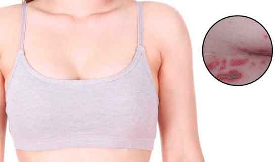 Hautausschlag zwischen den Brüsten Ursachen und Hausmittel