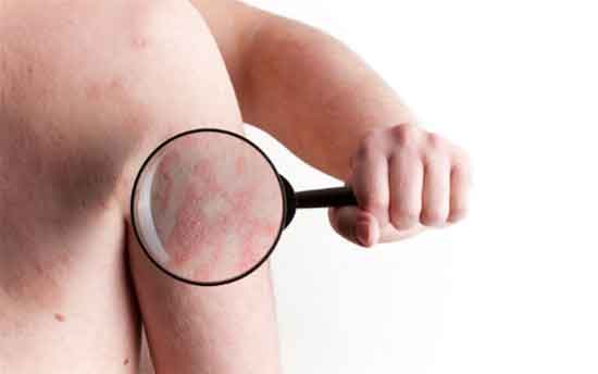 Livedo reticularis) Ursachen, Symptome, Behandlung