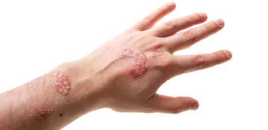 Psoriasis auf der Hand Ursachen, Behandlung, Prävention