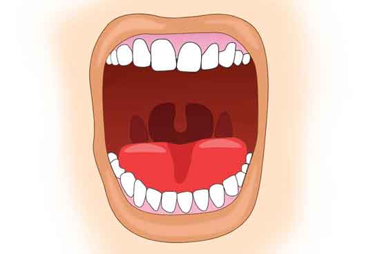 geschwollenes Zäpfchen (Uvulitis) Ursachen, Symptome, Behandlung