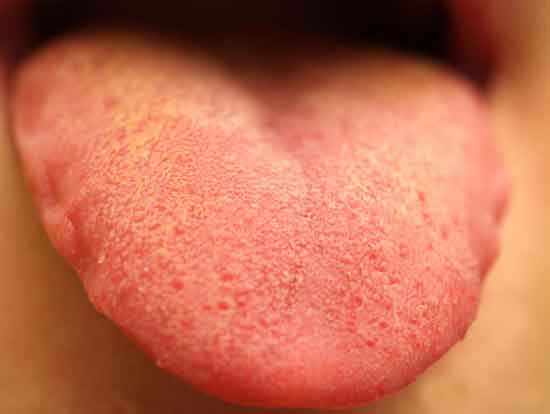 orangefarbene Zunge 6 Ursachen, 9 Symptome, Behandlung