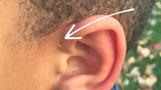 präaurikuläre Grube im Ohr Symptom, Ursache und Behandlung