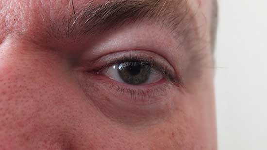 unebene Augenlider 8 mögliche Ursachen und Behandlung