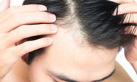 ungleichmäßiger Haaransatz 4 mögliche Ursachen und Behandlungsmöglichkeiten