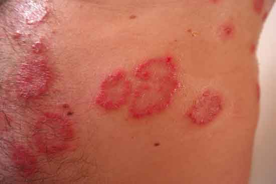 was ist Psoriasis Typ, Ursache, Symptom, Behandlung