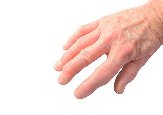 Psoriasis-Arthritis Symptome, Diagnose, Ernährung, Therapie