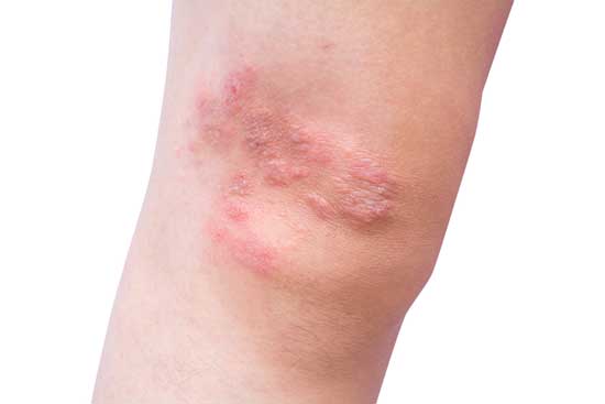 allergische Kontaktdermatitis Ursache, Symptom, Behandlung, Hausmittel