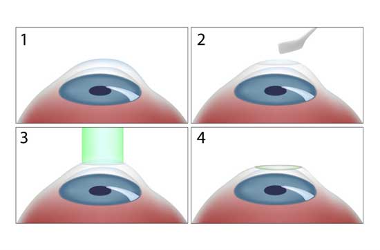 PRK-Erfahrung, PRK VS LASIK, Kosten, Nebenwirkungen