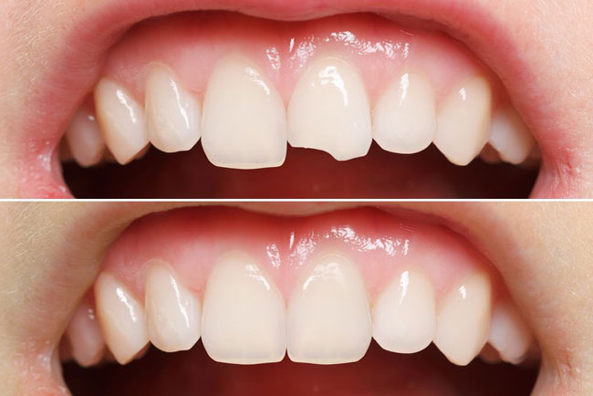 Zahnverbindungen Was ist zu erwarten, wenn Sie Ihre Zähne gebunden haben