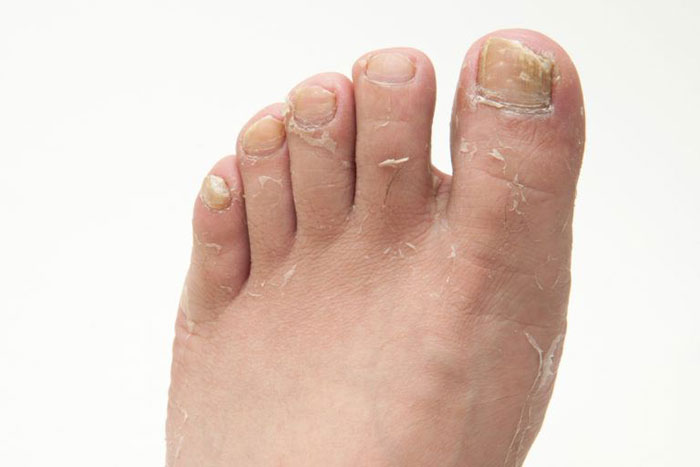 10 natürliche Möglichkeiten, Tinea pedis zu Hause zu behandeln!