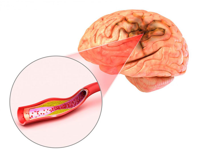 Aneurysma Ursachen, Symptome, Diagnose, Behandlung