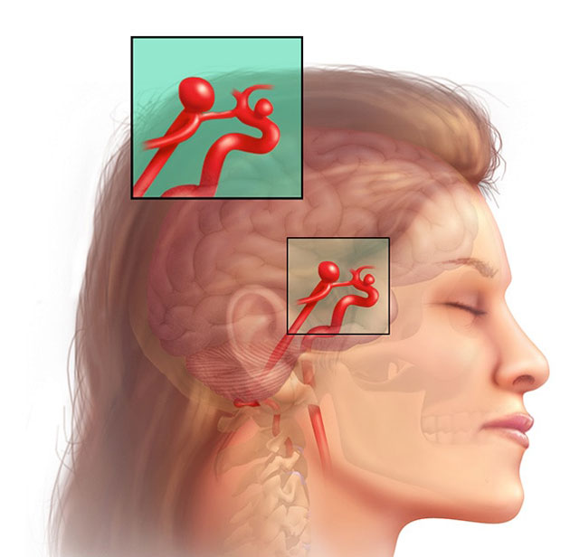 Aneurysma im Gehirn Ursachen, Symptome, Behandlung