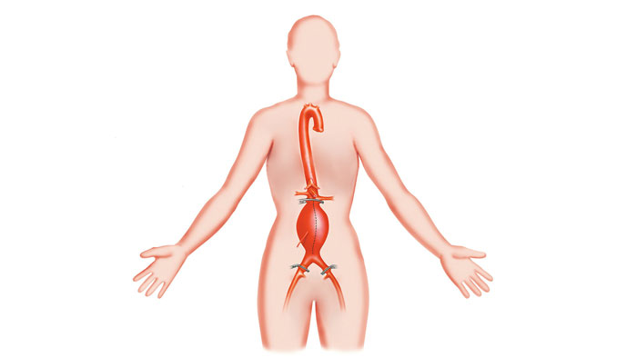 Aortenneurysma Ursachen, Symptome und Behandlung