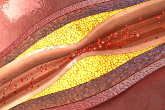 Atherosklerose Definition, Ursachen, Symptome, Behandlung