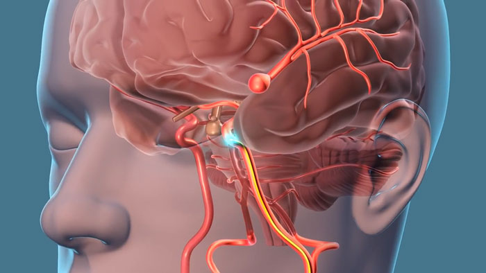 Beerenaneurysma Symptome, Ursachen und Behandlung