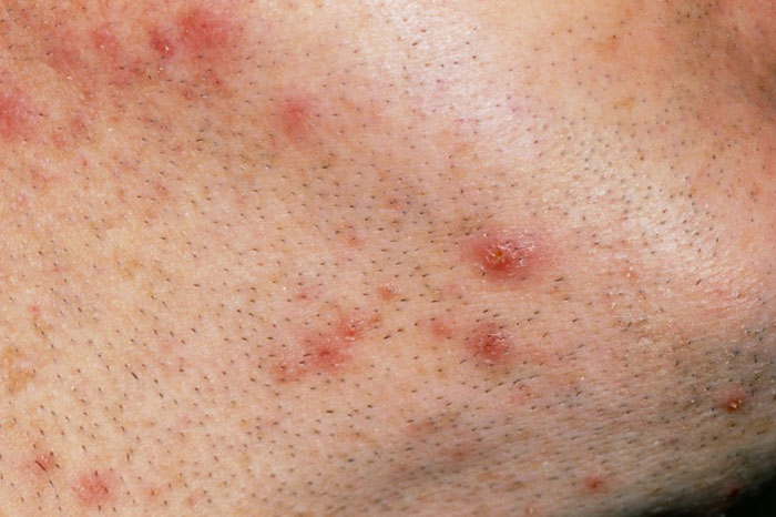 Follikulitis-Wiki Ursachen, Symptome, Behandlung