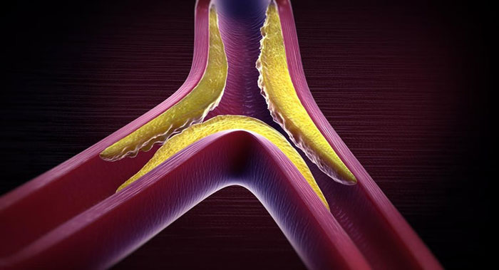 Hyperlipidämie Symptome, Ursachen, Behandlung