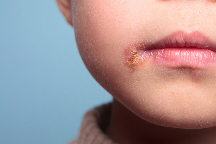 Impetigo Symptome, Ursachen, Behandlung, Typen