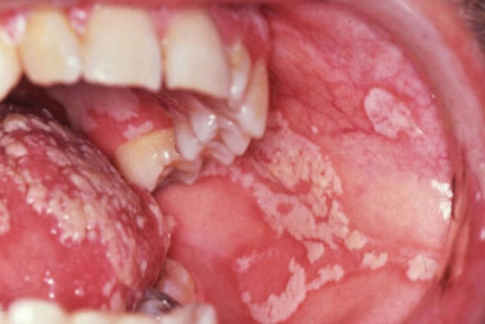 Ist die Munddrossel ansteckend Ursachen, Diagnose, Symptome, Behandlung