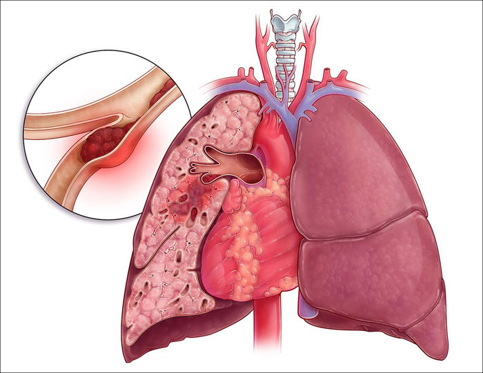 Lungenembolie Ursachen, Symptome, Risikofaktoren, Behandlung