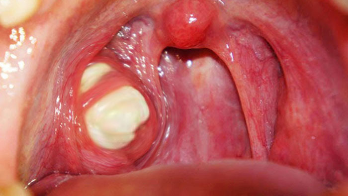 Mandelsteine (Tonsiliensteine) Ursachen, Symptome, Behandlungen, Entfernung, OP