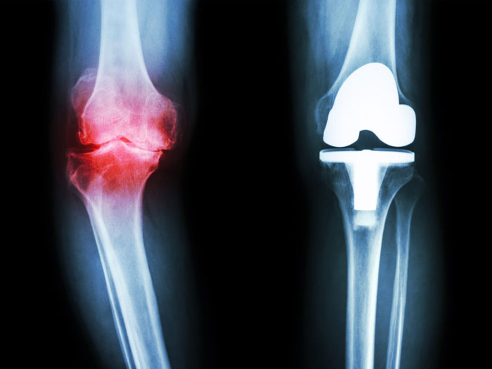 Osteoarthritis Symptome, Behandlungen und Ursachen, Ernährung