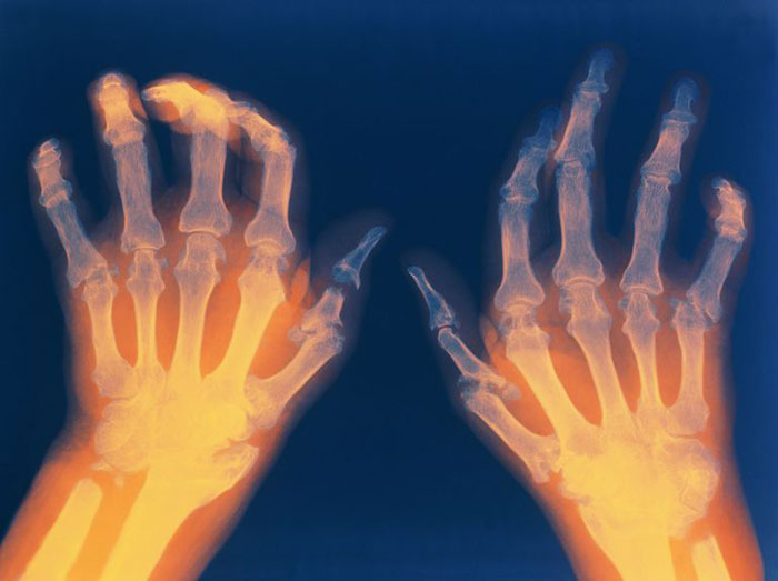 Rheumatoide Arthritis Symptome, Ursachen, Behandlung, Diagnose, Ernährung