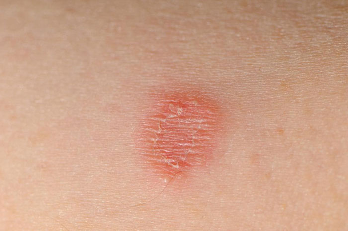 Ringworm Causes Symptoms Treatment Diagnosis Evolving World