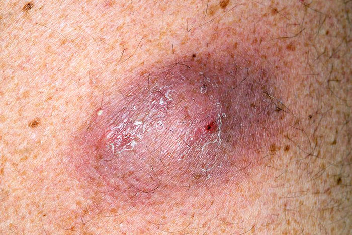 Talgdrüse Am Rücken Ausdrücken: Histologie Haut (derma, Cutis) Mit Talgdrüse Und Haar (pili) – Medical