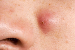 was ist eine Zyste: Ursachen, 13 Arten, Symptome, Behandlungen