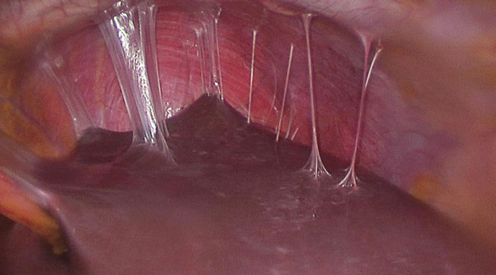 7 Möglichkeiten zur Behandlung von überschüssigem Schleim