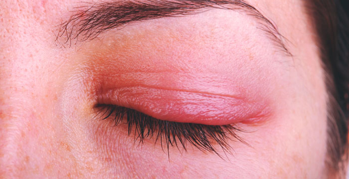 Augenlidentzündung (Blepharitis) Ursachen, Symptome, Behandlungen