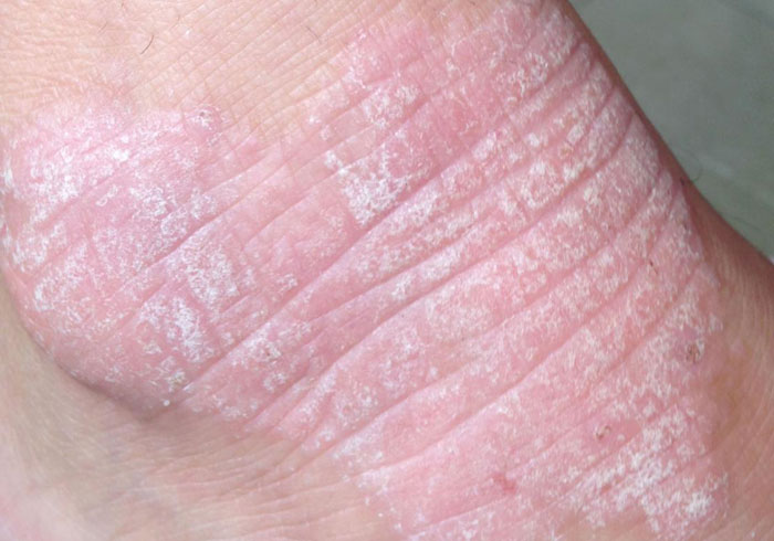 Dermatitis herpetiformis Ursachen, Behandlung, Diagnose (Morbus Duhring)