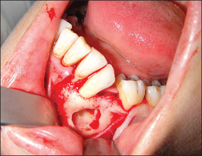 Gardner-Syndrom Symptome, Ursachen, Behandlung