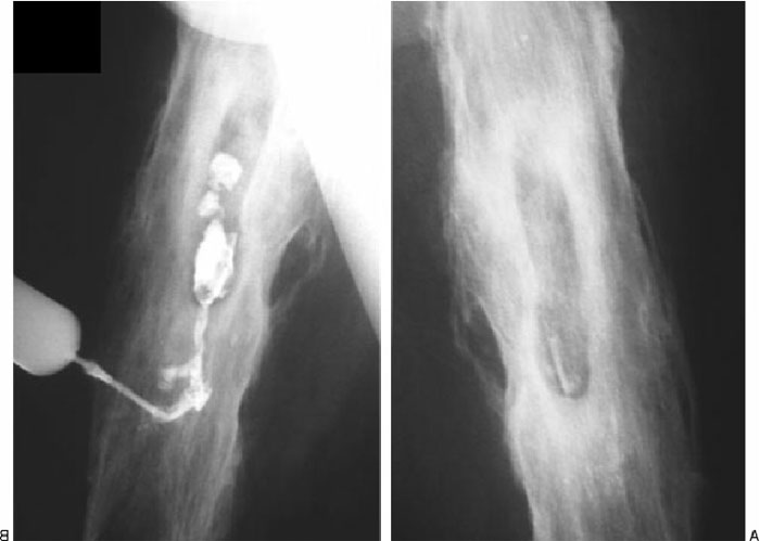 Knocheninfektion (Osteomyelitis) Ursachen, Symptome, Behandlung