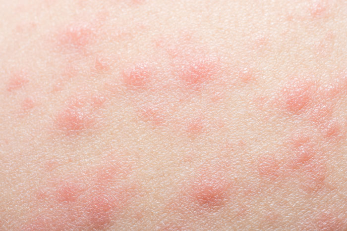 Kontaktdermatitis Arten, Ursachen, Symptome, Behandlung