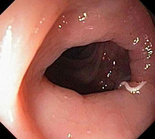 Madenwurm-Infektion Symptome, Diagnose, Behandlung, Prävention, Hausmittel