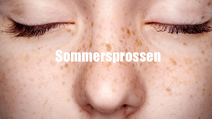 Sommersprossen Ursachen, Behandlung, Prävention