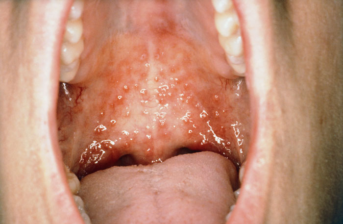 Stomatitis Ursachen, Symptome, Behandlung, Prävention