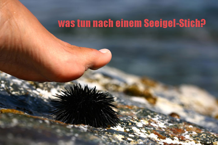 Symptome von Seeigel-Stich und Heimbehandlung